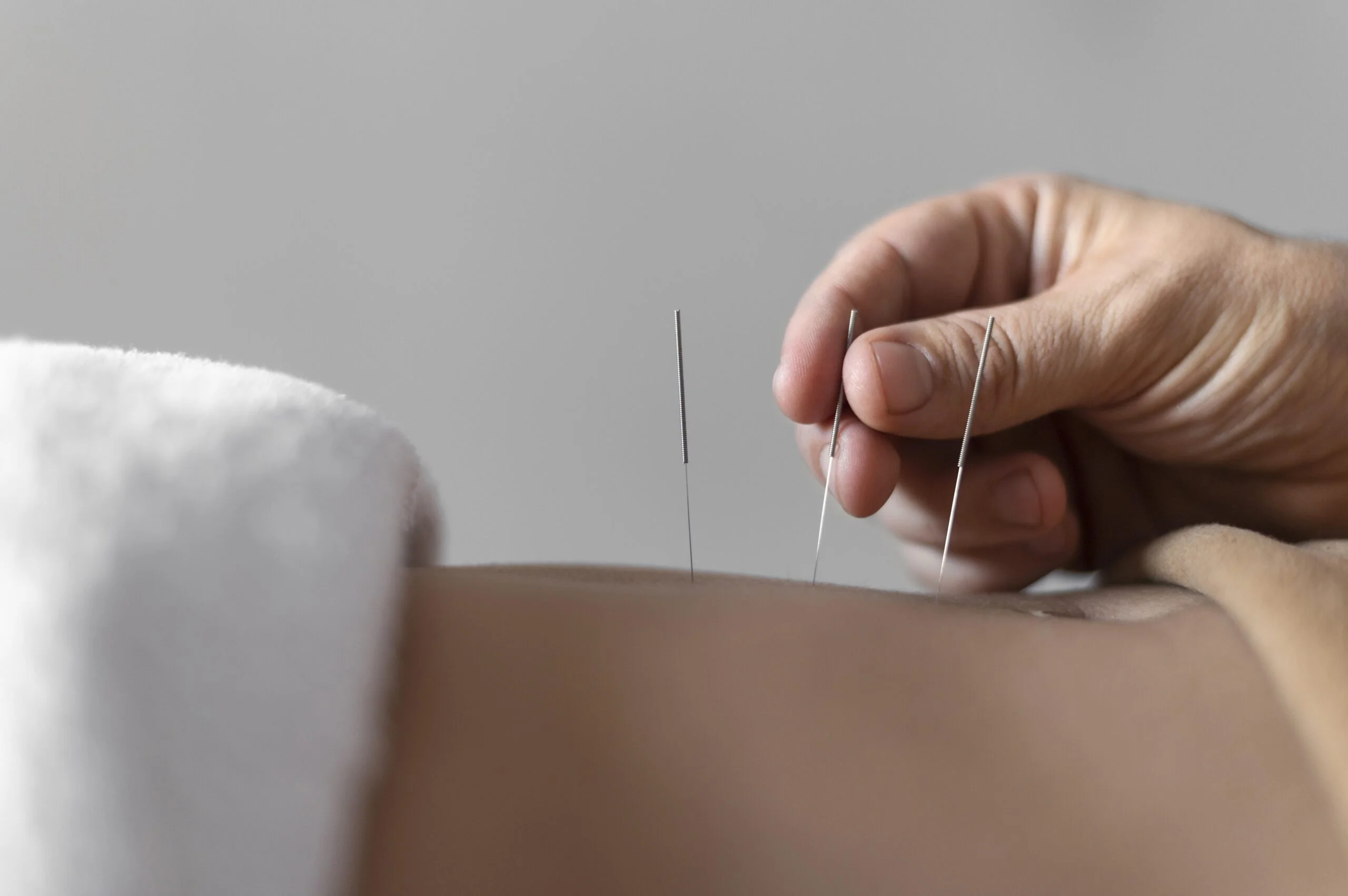 Dry Needling Dubai